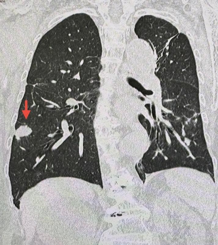 ปอดอักเสบ เพราะนกพิราบ