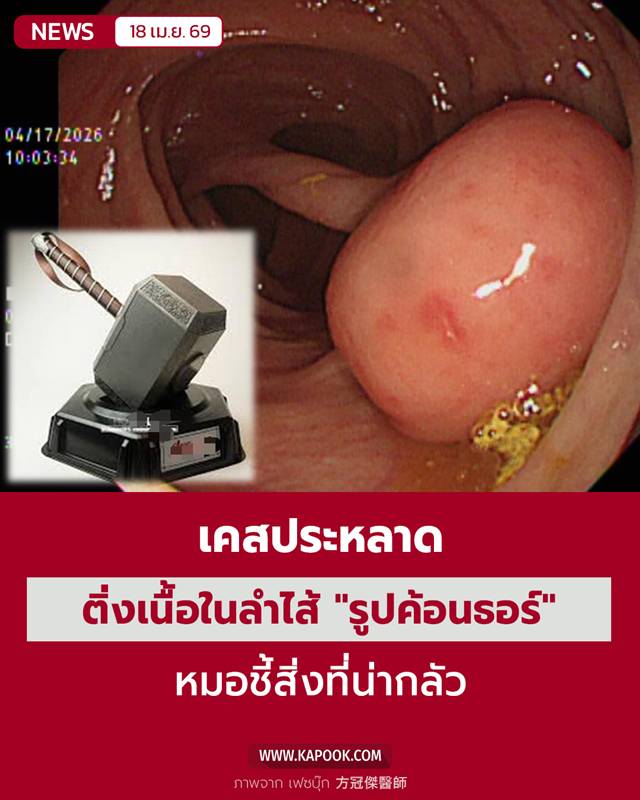 ติ่งเนื้อในลำไส้