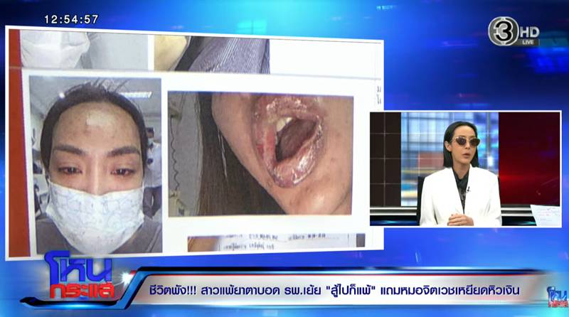 Stevens-Johnson Syndrome