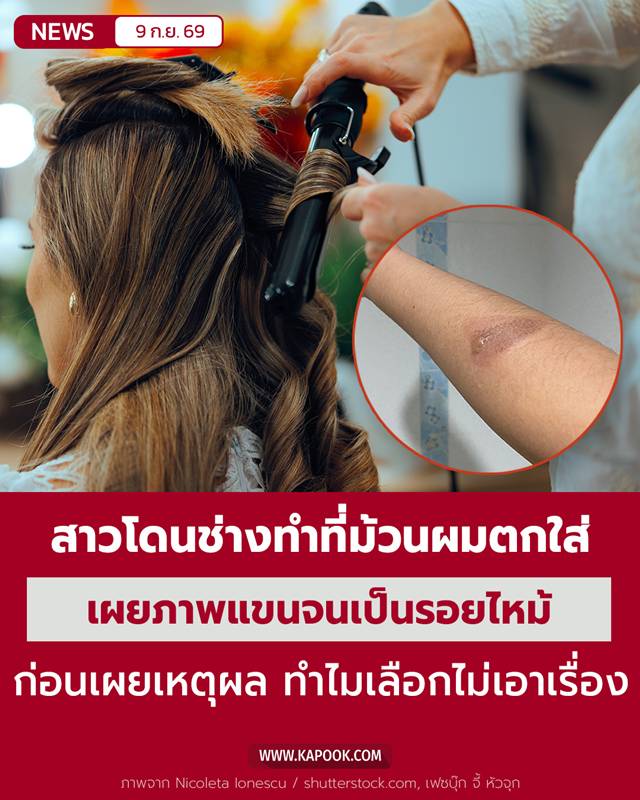 แผลไหม้