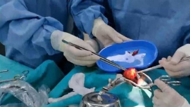 แฝดปรสิต