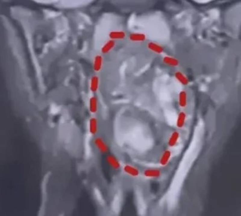 แฝดปรสิต