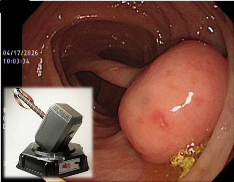 ติ่งเนื้อในลำไส้