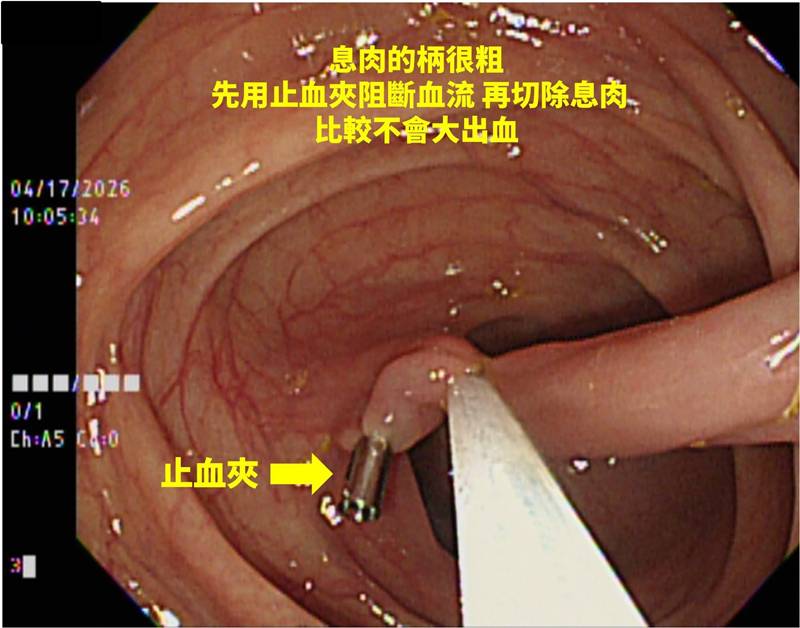 ติ่งเนื้อในลำไส้
