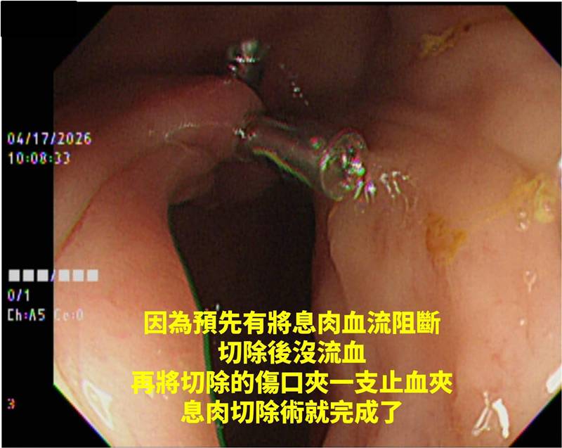 ติ่งเนื้อในลำไส้