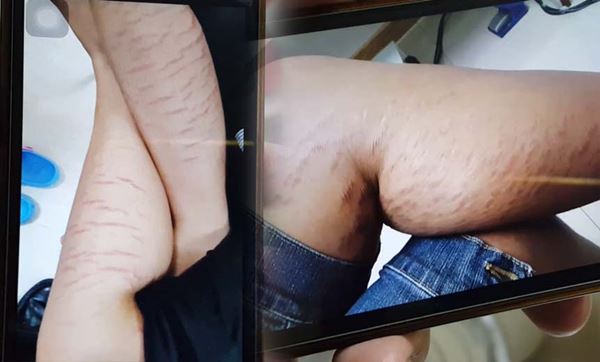 ครีมเถื่อน