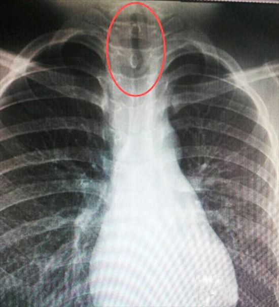 ขนลุก ปลิงเติบโตในคอเด็กชาย ผ่าออกมาได้ตัวขนาดนี้