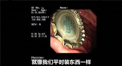 ทีมแพทย์ปฏิบัติการดึงฝาเบียร์ออกจากท้อง 