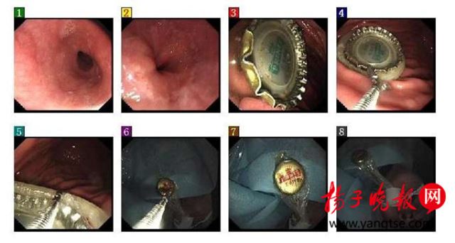 ทีมแพทย์ปฏิบัติการดึงฝาเบียร์ออกจากท้อง 