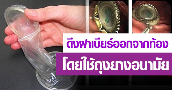 ทีมแพทย์ปฏิบัติการดึงฝาเบียร์ออกจากท้อง