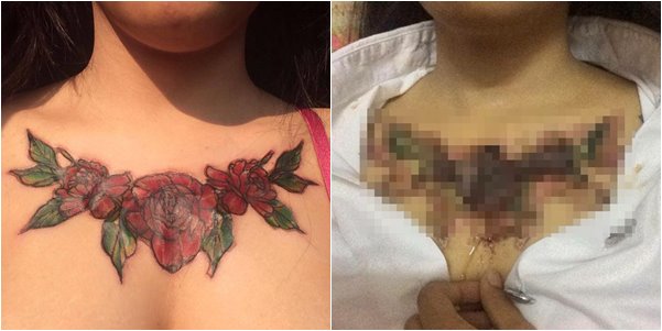 ลบรอยสัก