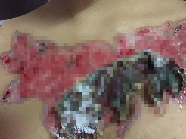 ลบรอยสัก