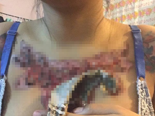 ลบรอยสัก