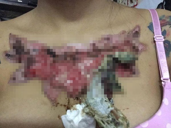 ลบรอยสัก