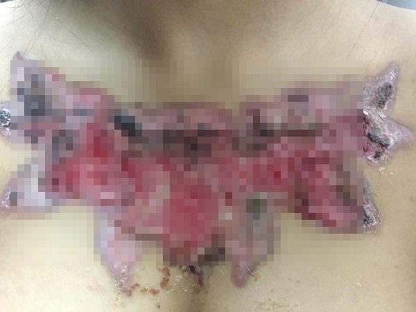 ลบรอยสัก