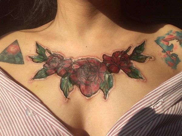 ลบรอยสัก