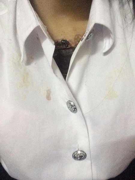 ลบรอยสัก