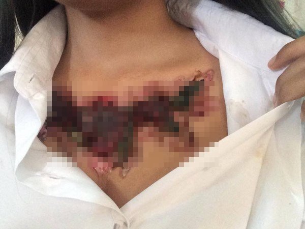 ลบรอยสัก