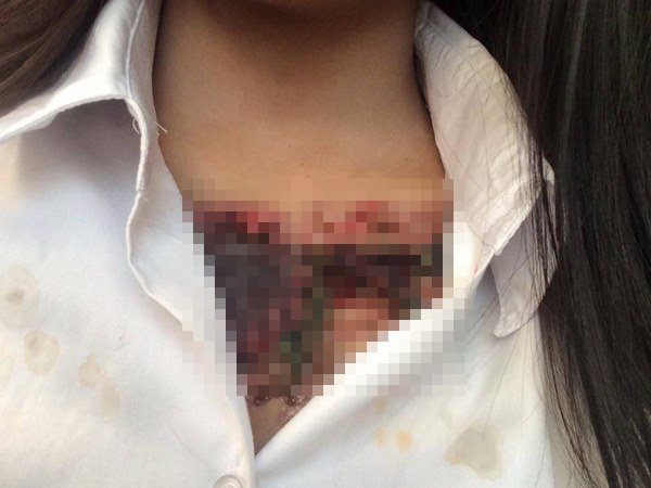 ลบรอยสัก