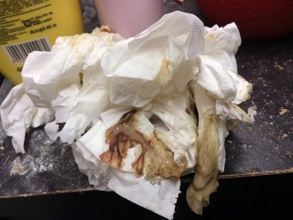 ลบรอยสัก