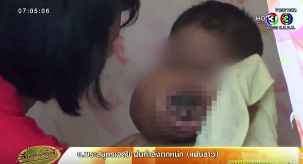 วอนช่วย เด็กชาย 5 ขวบ ป่วยมะเร็งบนใบหน้า