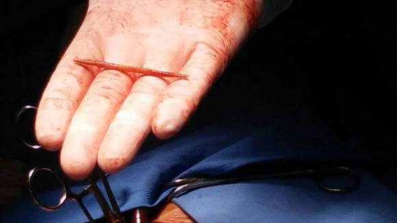 รอดหวุดหวิด ชายสวาปามขนม ทำไม้จิ้มฟันทิ่มคาหัวใจกว่า 6 เดือน