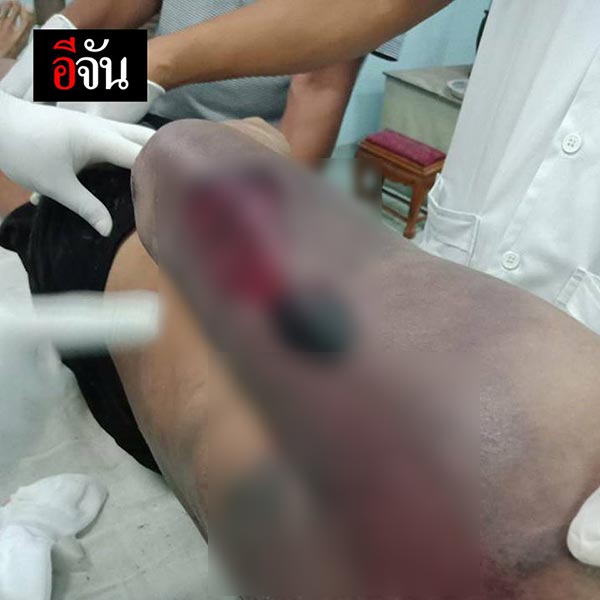 แฟนตายในคุก หมอบอกสำลักข้าวดับ