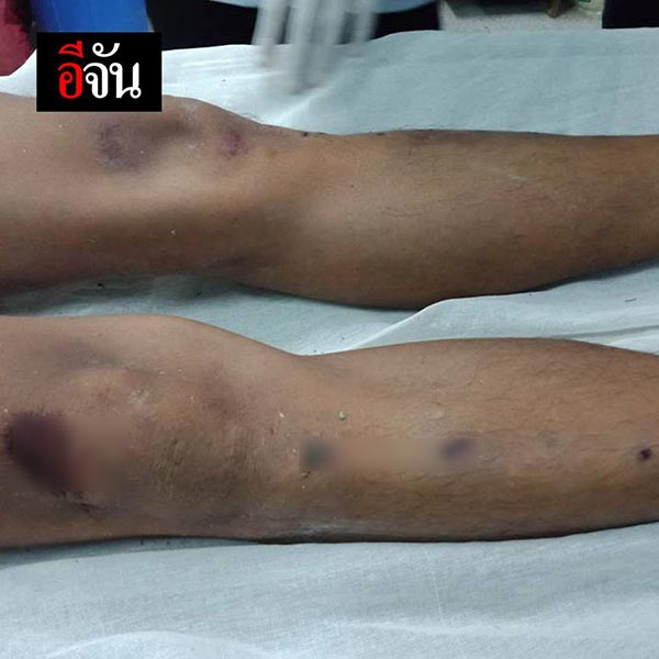 แฟนตายในคุก หมอบอกสำลักข้าวดับ