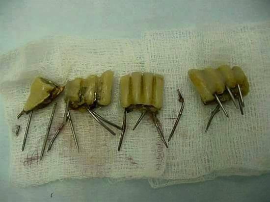 ฟันปลอมเถื่อน