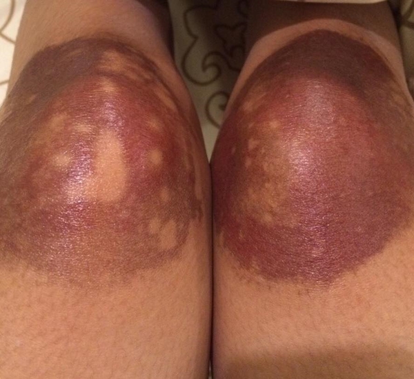 เตือน ! สาว ๆ อย่าใช้ยาผิดสรรพคุณ-คำเตือน ไม่งั้นอาจเป็นแบบนี้