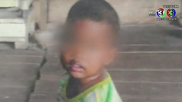 วอนช่วย เด็กชาย 5 ขวบ ป่วยมะเร็งบนใบหน้า