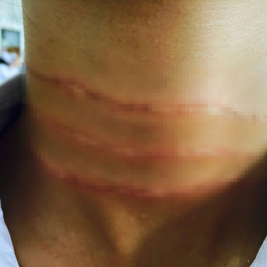 เตือนภัยระวังโจรขึงลวด-เอ็นขวางถนน ทำสาว 16 หวิดดับ