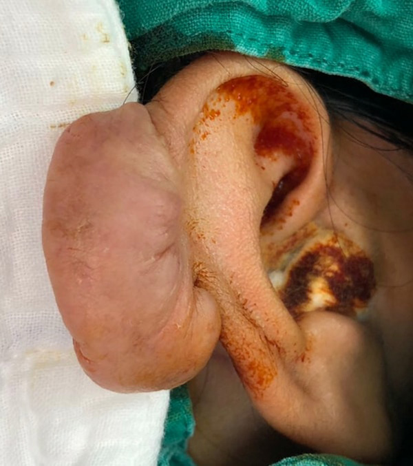 ภาพข่าว เจาะหู