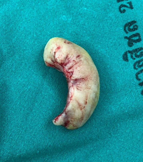 ภาพข่าว เจาะหู