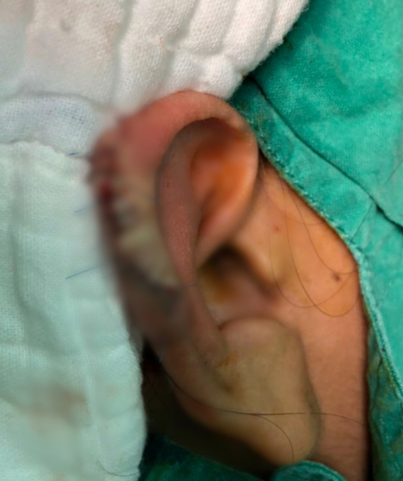 ภาพข่าว เจาะหู