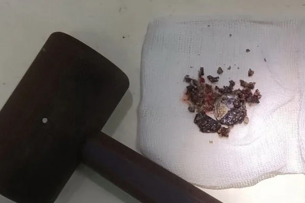 เหรียญใส่จมูก