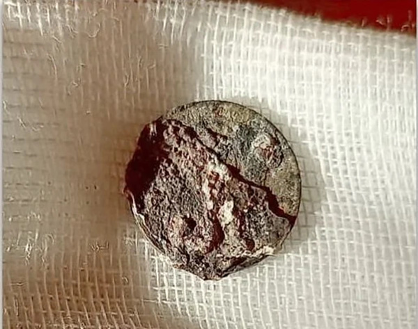 เหรียญใส่จมูก