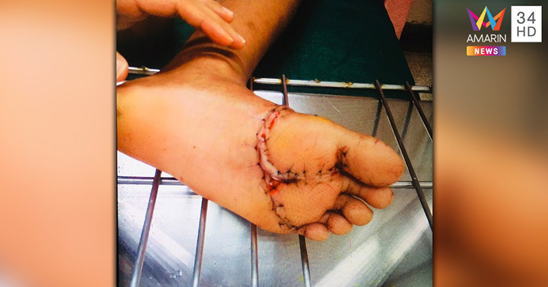 ภาพข่าวฉลามกัด