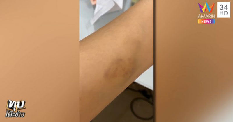 ถูกแฟนทำร้าย