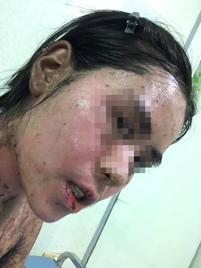 อุทาหรณ์กินไอบูโพรเฟน