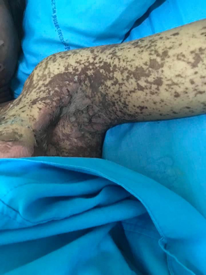 อุทาหรณ์กินไอบูโพรเฟน