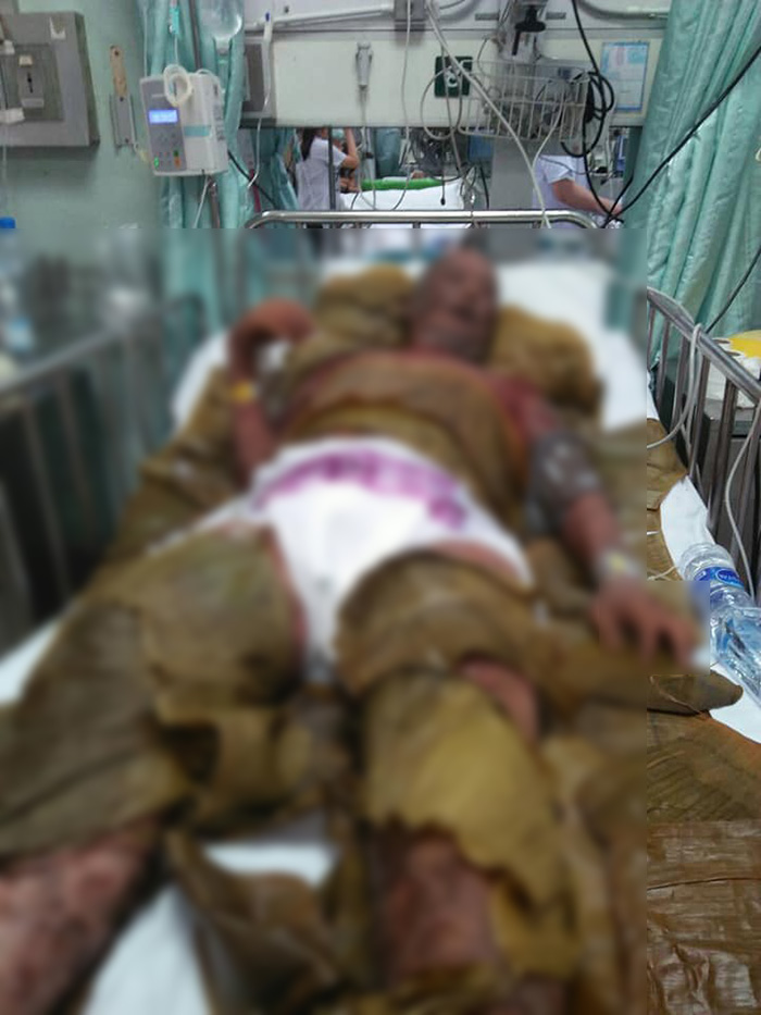 ภาพข่าวลุงแพ้ยารุนแรง