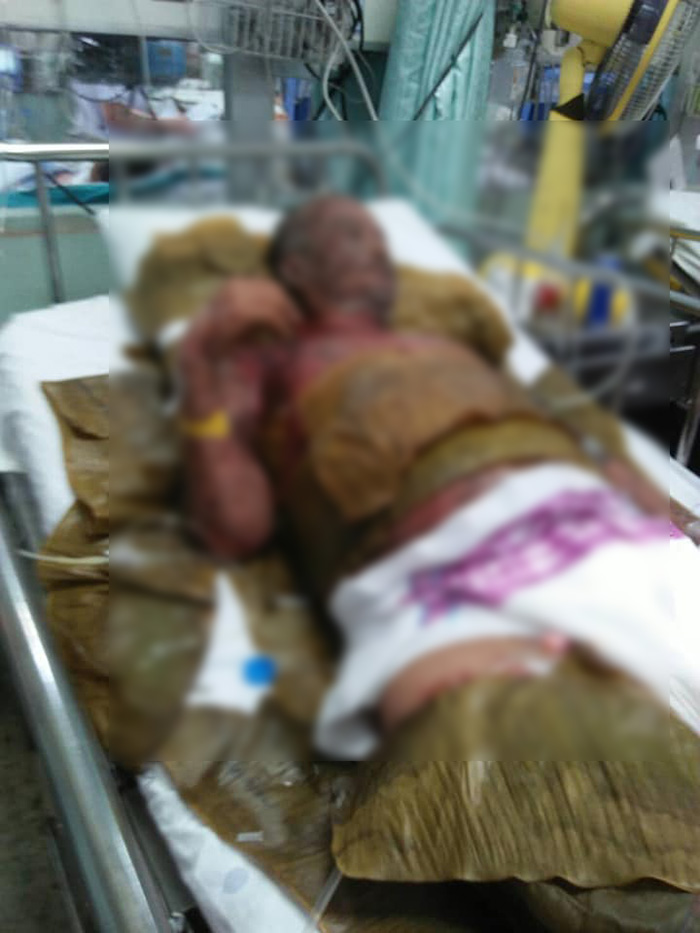 ภาพข่าวลุงแพ้ยารุนแรง