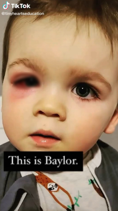 ลูกชายติดเชื้อ