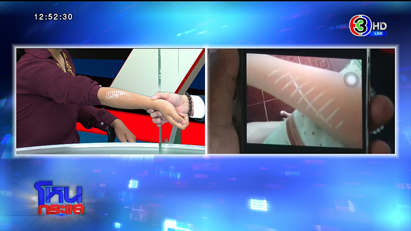 รอยก้างปลาปริศนาโผล่ที่แขน ด.ญ. วัย 13