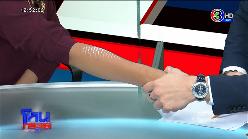 รอยก้างปลาปริศนาโผล่ที่แขน ด.ญ. วัย 13