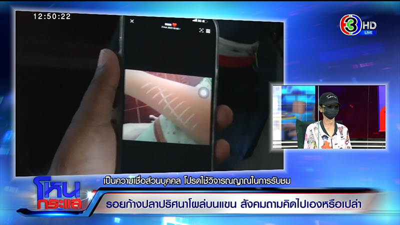 รอยก้างปลาปริศนาโผล่ที่แขน ด.ญ. วัย 13