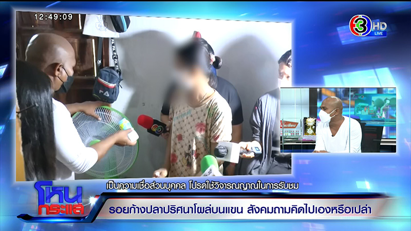 รอยก้างปลาปริศนาโผล่ที่แขน ด.ญ. วัย 13