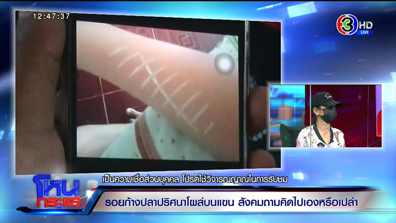 รอยก้างปลาปริศนาโผล่ที่แขน ด.ญ. วัย 13