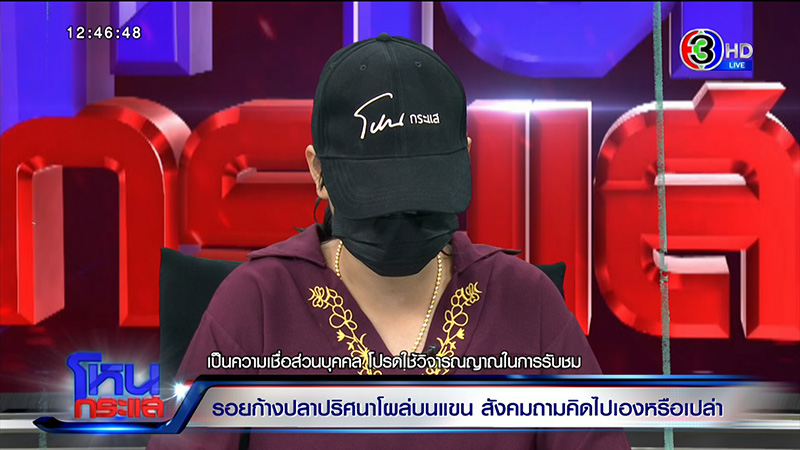 รอยก้างปลาปริศนาโผล่ที่แขน ด.ญ. วัย 13